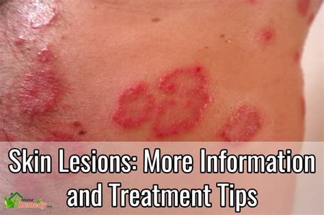 Skin Lesions: More Information and Treatment Tips - Home Remedies