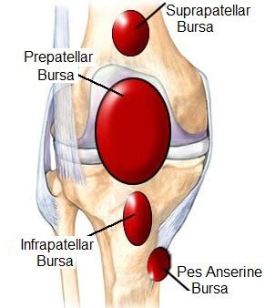 Lateral Bursitis Knee