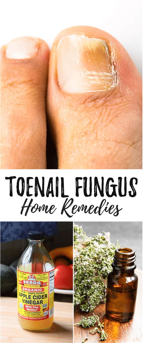 Toenail Fungus Cures That Really Work