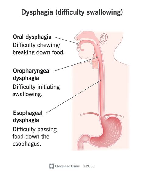 Understanding Dysphagia: Causes, Symptoms, And Treatment - Ask The Nurse Expert