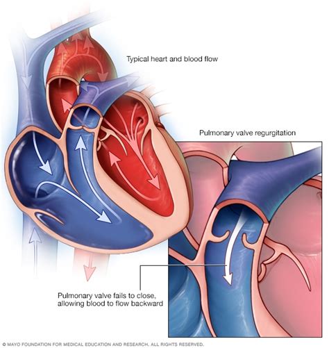 Pulmonary valve repair and replacement - Mayo Clinic