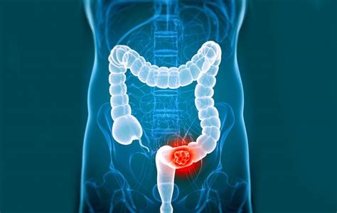 23 Signs And Symptoms Of Colorectal Cancer