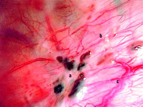 Endometriosis | The BMJ