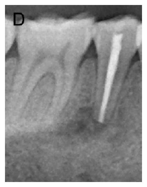 Radiographs. (a) Radiograph at the initial visit showing a large... | Download Scientific Diagram