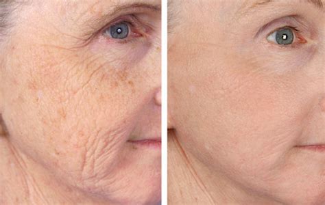 Wrinkle Reduction Denver Centennial DTC | Laser Aesthetics of Colorado