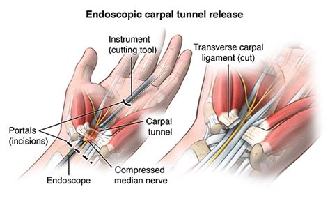 Carpal Tunnel Surgery | Neuroaxis