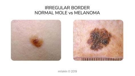 Melanoma Pictures | Skin Melanomas vs. Non-Cancerous Moles