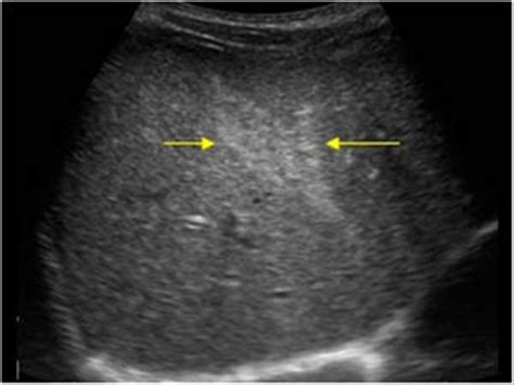 Abdomen and retroperitoneum | 1.1 Liver : Case 1.1.14 Liver Trauma | Ultrasound Cases