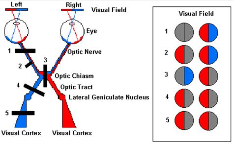 Higher Optic Pathway Lesion - Net Health Book