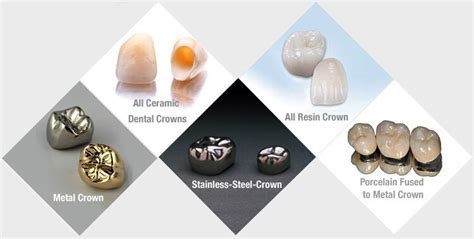 Dental Crown Guide & its Types - Why Dental crown Required | US Dental