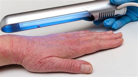 Phototherapy For Eczema