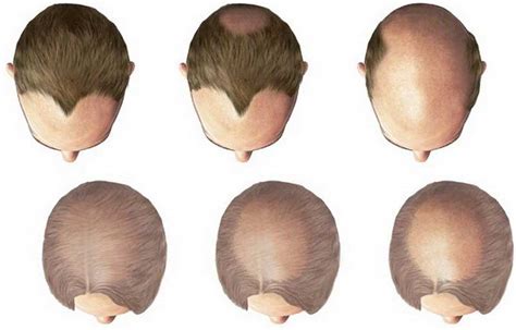 How to Deal with Androgenic Alopecia (AGA)