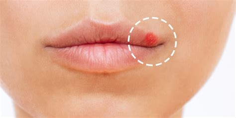 How To Get Rid Of Lip Pimple: Useful Tips