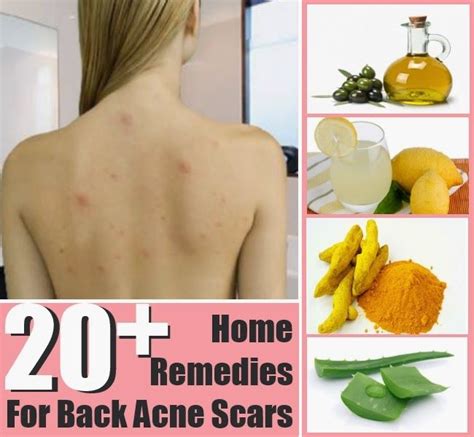 86 New Acne on chest and back home remedies for Living room | Home Design Ideas