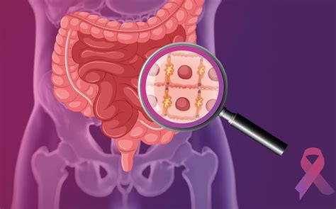 Colorectal cancer & Treatment - Curia App