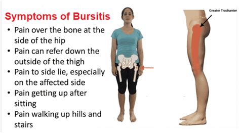 Hip Bursitis Symptoms Hip Bursitis Symptoms Bursitis Symptoms Images | Images and Photos finder