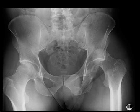 Pre-operative X-ray of the pelvis, AP, showing fracture-dislocation... | Download Scientific Diagram