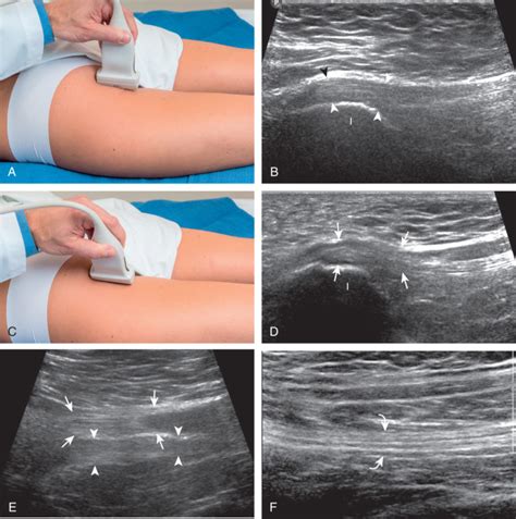 Hip and Thigh Ultrasound | Radiology Key