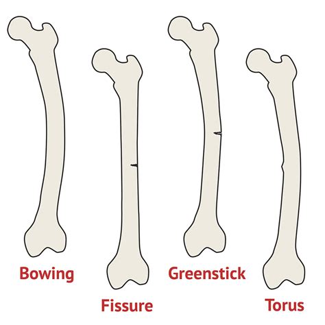 Incomplete Fractures | Test Findings - MedSchool