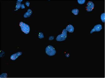 Representative example of c-KIT gene amplification detected by ...