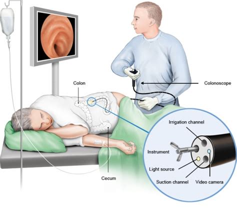 Colonoscopy Procedure