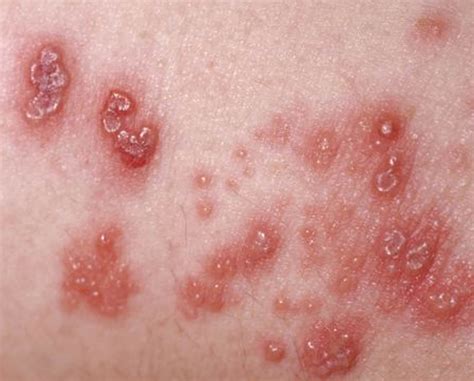 Shingles - Causes, Symptoms, Home Remedies, Treatment