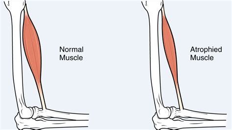 Muscle Atrophy Latest Facts: Causes, Types, Symptoms and Treatment ...