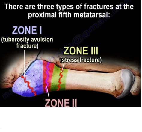 Jones fracture of the 5th Metatarsal — OrthopaedicPrinciples.com