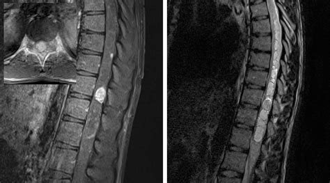 Intramedullary Spinal Cord Tumor | The Neurosurgical Atlas