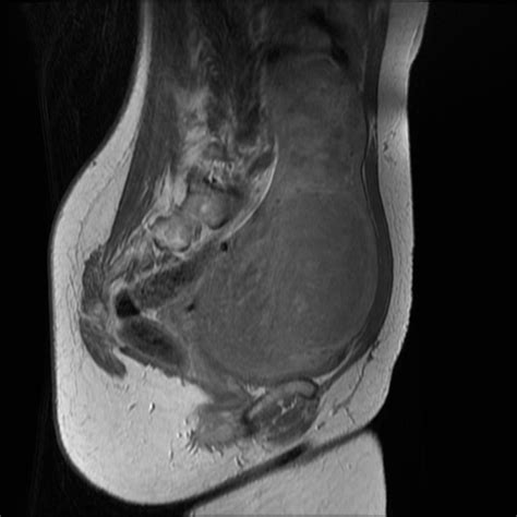 Sag FSE-T1w+Gd showing a uterine length over 20 cm with multiple ...