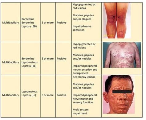 Signs and Symptoms - Leprosy