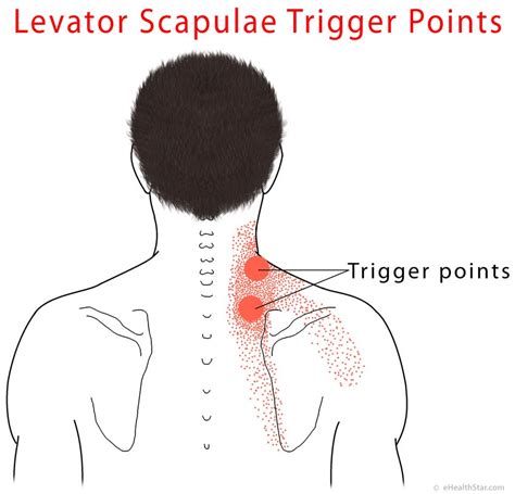 Levator Scapulae Pain Syndrome, Trigger Points, Stretch - eHealthStar