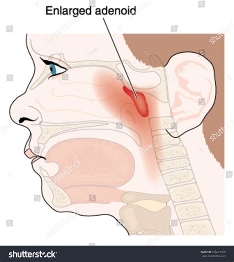 Enlargement Of Adenoid Glands In Children, Showing The Anatomic ...