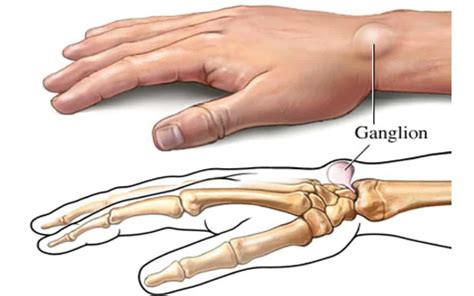 Ganglion Cyst - Mississauga Chiropractor and Physiotherapy Clinic - FREE Consult!