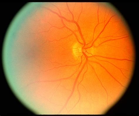 Infiltrative Cancer of the Optic Nerve - Retina Image Bank