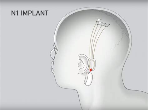 Neuralink Chip Never Damages Nervous System or Cause Any CSF Leak, Says Elon Musk