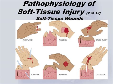 PPT - Chapter 5 Soft-Tissue Trauma PowerPoint Presentation, free download - ID:1214059