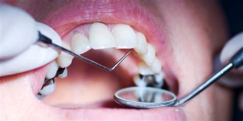 Can You Actually Get Rid Of A Cavity Without Going Under The Drill? - WSTale.com