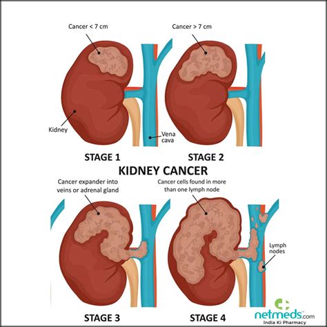 How To Diagnose Kidney Cancer - Soupcrazy1