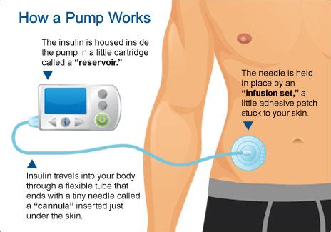 Insulin Pumps: Types, Advantages, Disadvantages & Cost » How To Relief