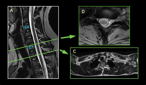 MRI BLOG: Brachial Plexus MRI (I/II)