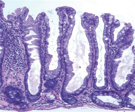 Sessile Polyp Histology