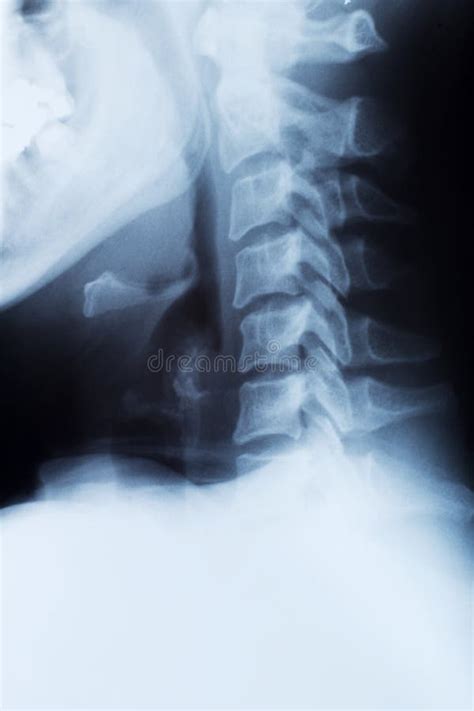 X-ray of a cervical spine stock photo. Image of contrast - 23307582