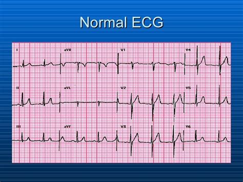 Ecg interpretation