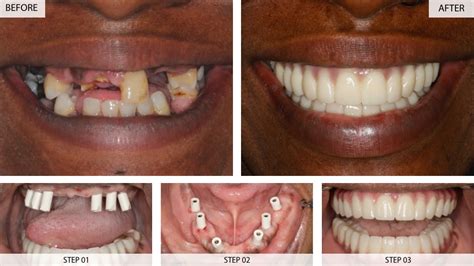 Dental Implants Results (Before & After) - 22 Cases