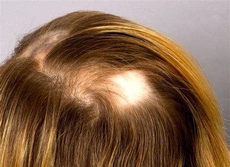 Alopecia Areata Success Story – Healing It Naturally with THIS Method