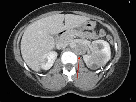 Kidney Mass Ct Scan