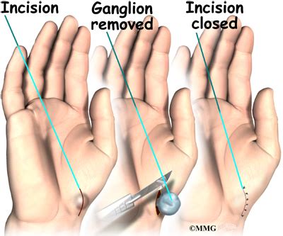 Ganglion Excision - St. George Surgical Center