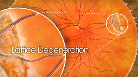 Lattice degeneration causes, treatments and surgery