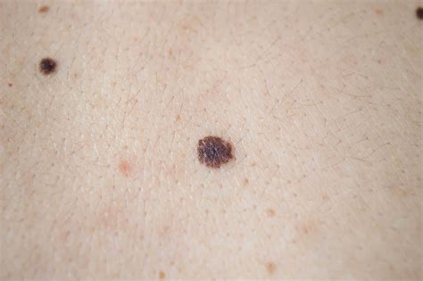 Early Stage Melanoma Images